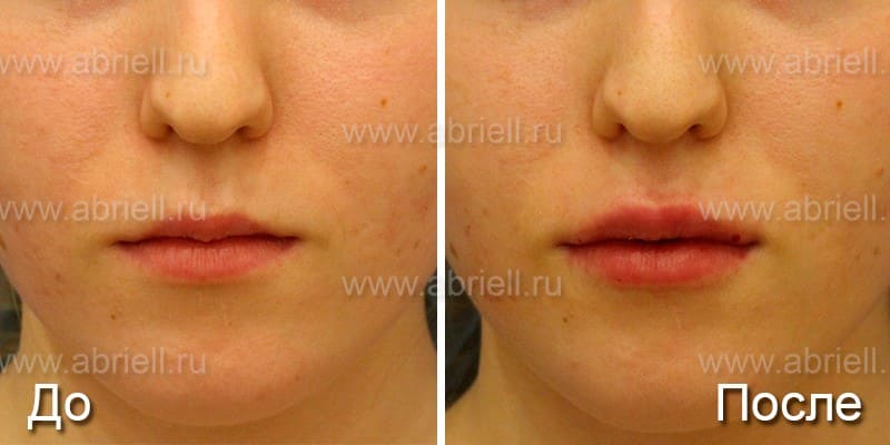 Увеличение губ гиалуроновой кислотой (фото до и после)